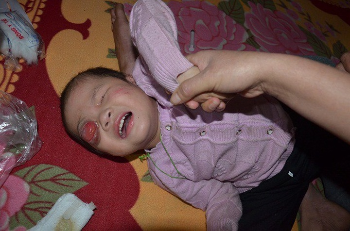 Little ethnic minority girl struggling with retinoblastoma - 1