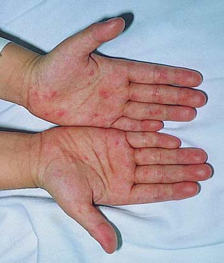 3-year-old child dies of suspected hand-foot-mouth disease - 1