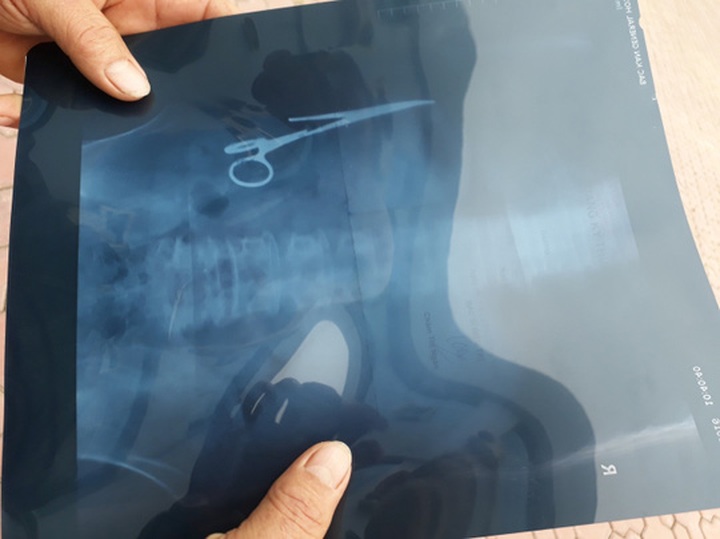 Scissors found in man's abdomen after 18 years - 2