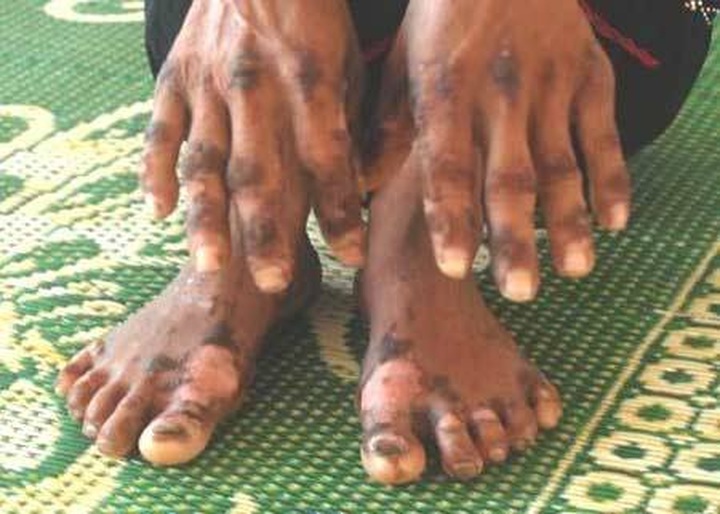 Doctors unable to cure mystery disease - 1