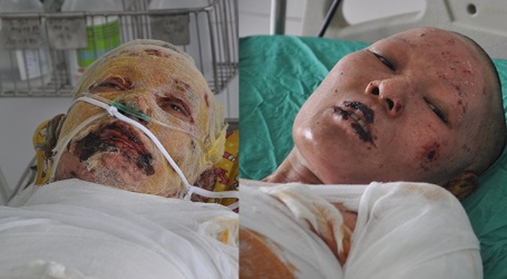 Dao burn victims need urgent help - 1 Dao burn victims need urgent help - 1