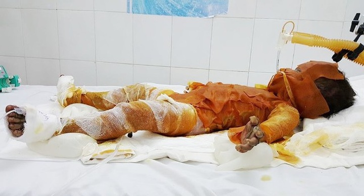 Little girl struggling with serious burns - 1