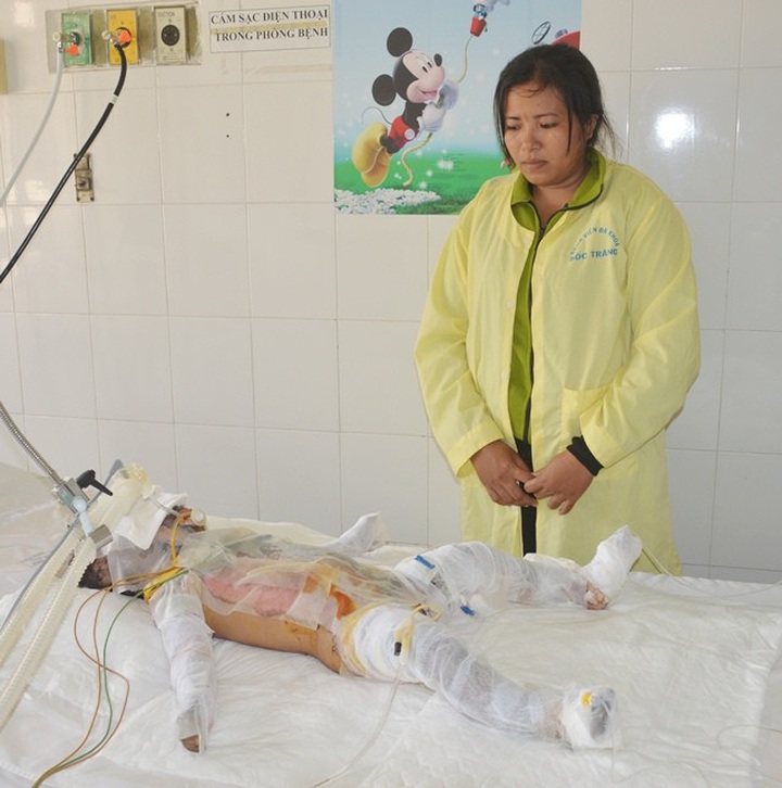 Little girl struggling with serious burns - 2