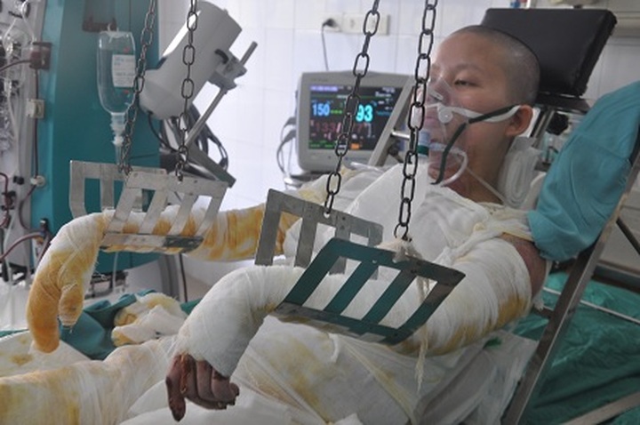 Seriously burnt young mother calls for help - 1 Seriously burnt young mother calls for help - 1