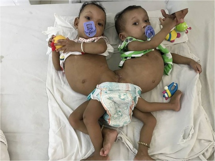 Rare case of twins conjoined at pelvis separated - 1