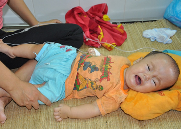 Baby struggles with hydrocephalus - 2 Baby struggles with hydrocephalus - 2