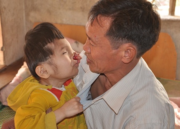 Eight-year old boy with facial deformity - 2 Eight-year old boy with facial deformity - 2