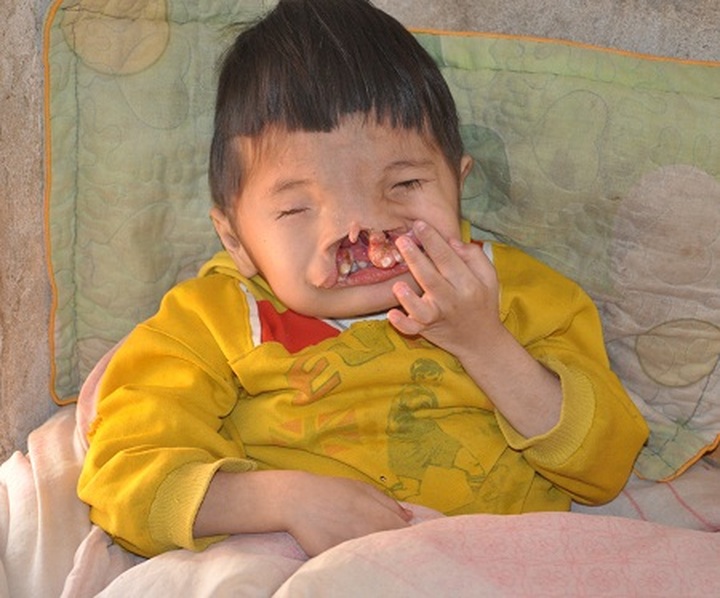 Eight-year old boy with facial deformity - 1 Eight-year old boy with facial deformity - 1