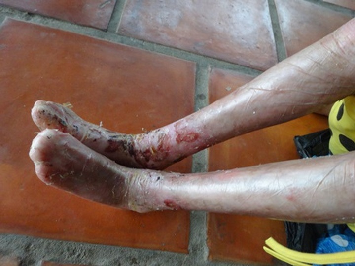 Little 'butterfly child' fights rare skin disease - 1