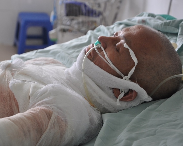 Wife faces ending treatment for badly burned husband - 1