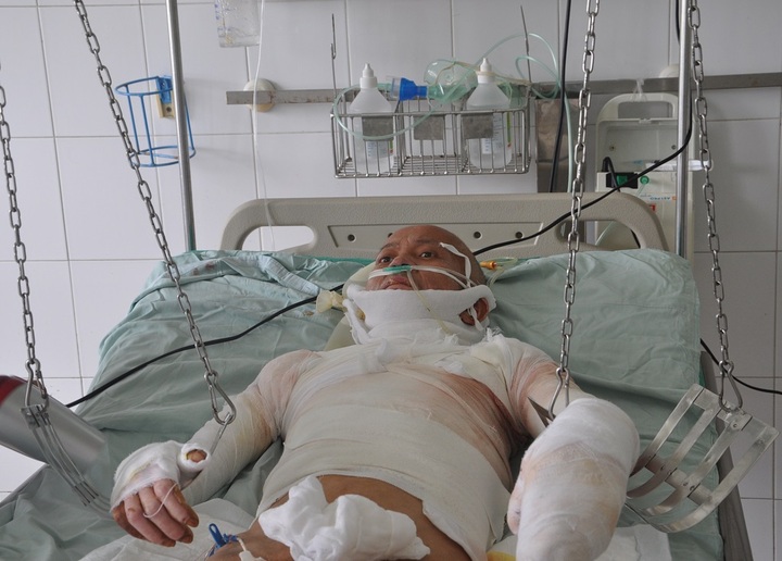 Wife faces ending treatment for badly burned husband - 3