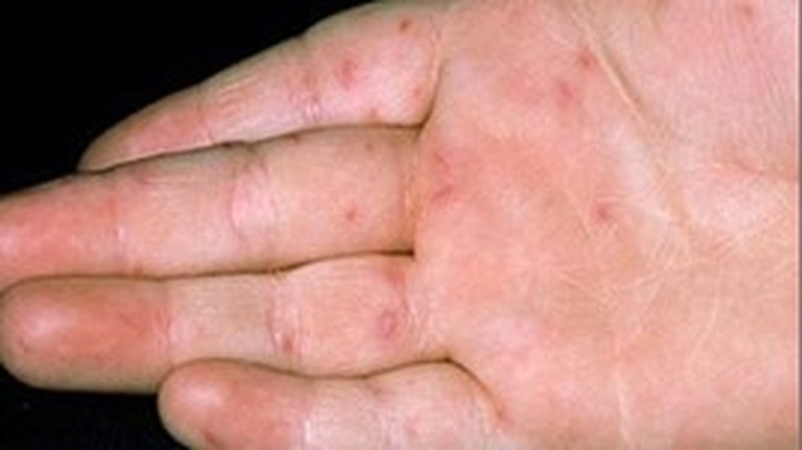 Hand, foot and mouth disease strikes Hanoi - 1