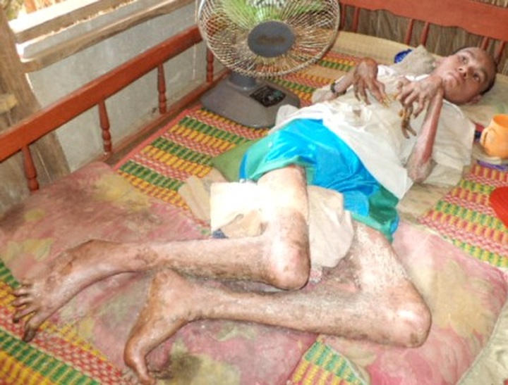 Khmer man bedridden for years due to deformed limbs - 2 Khmer man bedridden for years due to deformed limbs - 2