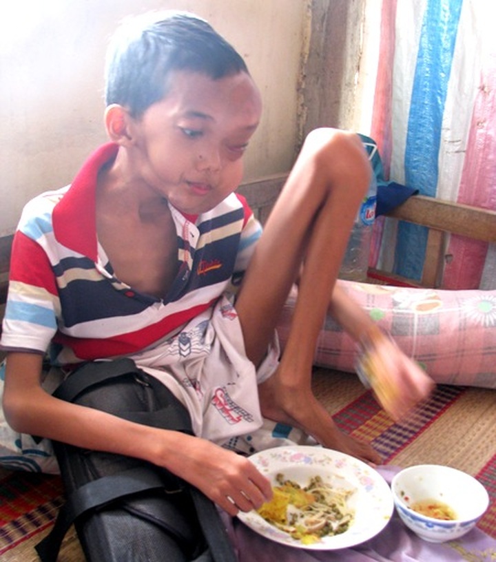 Boy struggling for bone cancer fights for life - 2 Boy struggling for bone cancer fights for life - 2