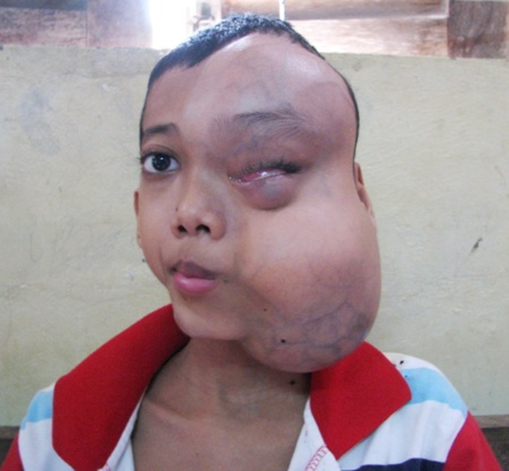 Boy struggling for bone cancer fights for life - 1 Boy struggling for bone cancer fights for life - 1