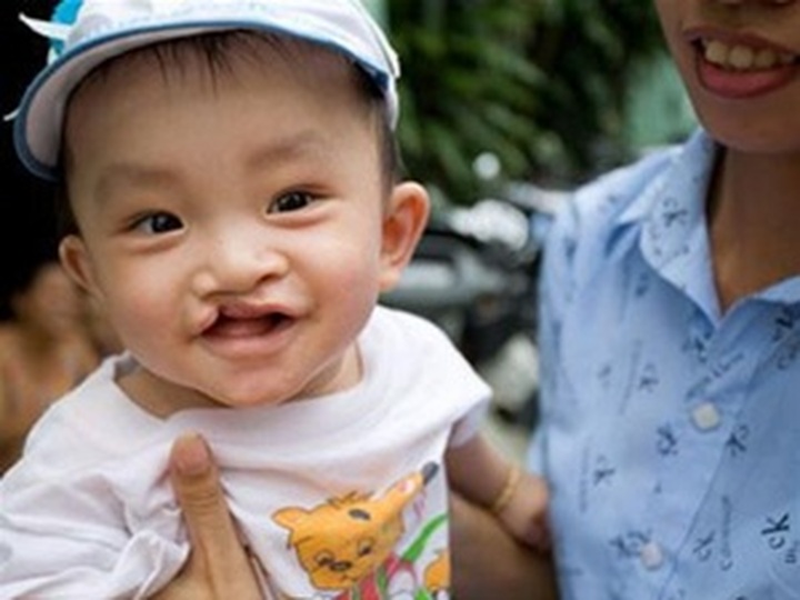 Operation Smile to visit An Giang in April - 1