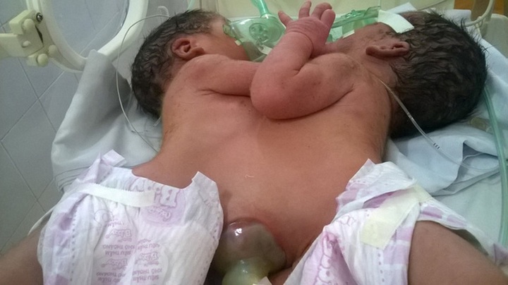 Ha Giang woman gives birth to conjoined twins - 1