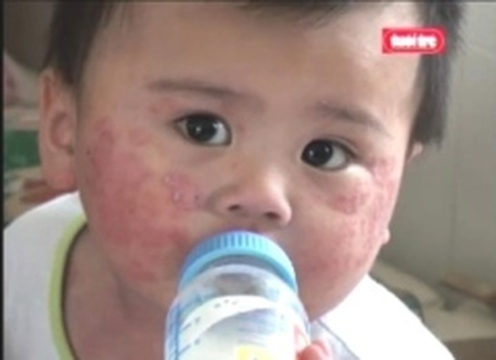 100% of HFMD patients killed by EV71 virus - 1