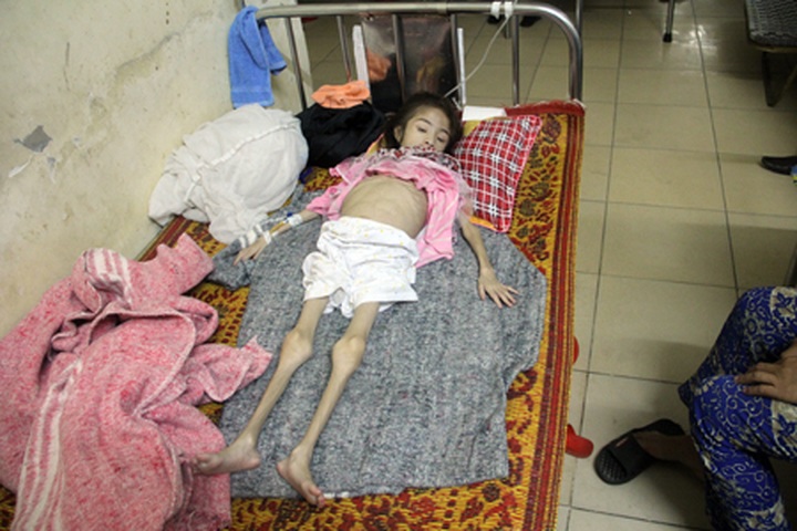 Little hope for 12-year old girl who weighs only 4 kilos - 1