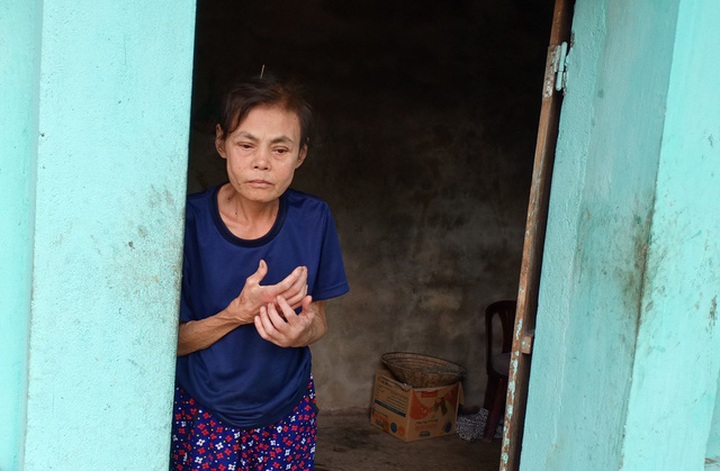Ailing poor woman takes care of cerebral palsy son - 2 Ailing poor woman takes care of cerebral palsy son - 2