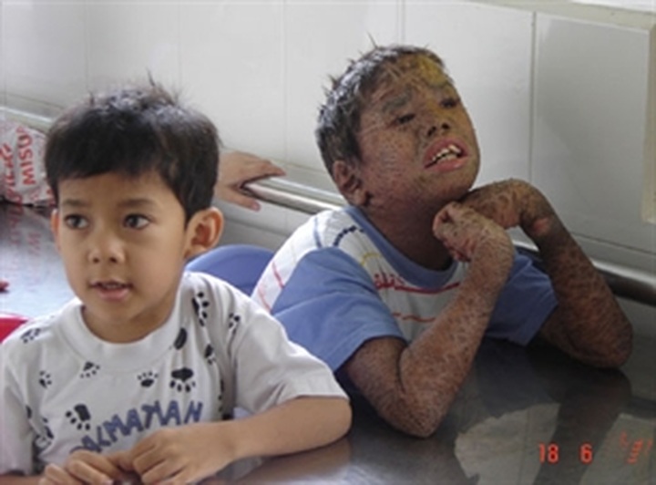 UK MPs raise funds for Vietnamese AO victims - 1 UK MPs raise funds for Vietnamese AO victims - 1