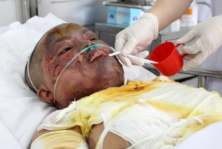 Seriously burnt woman issues plea for help - 1