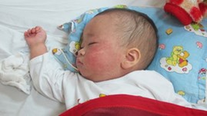 Measles cases on the rise, 3 dead - 1