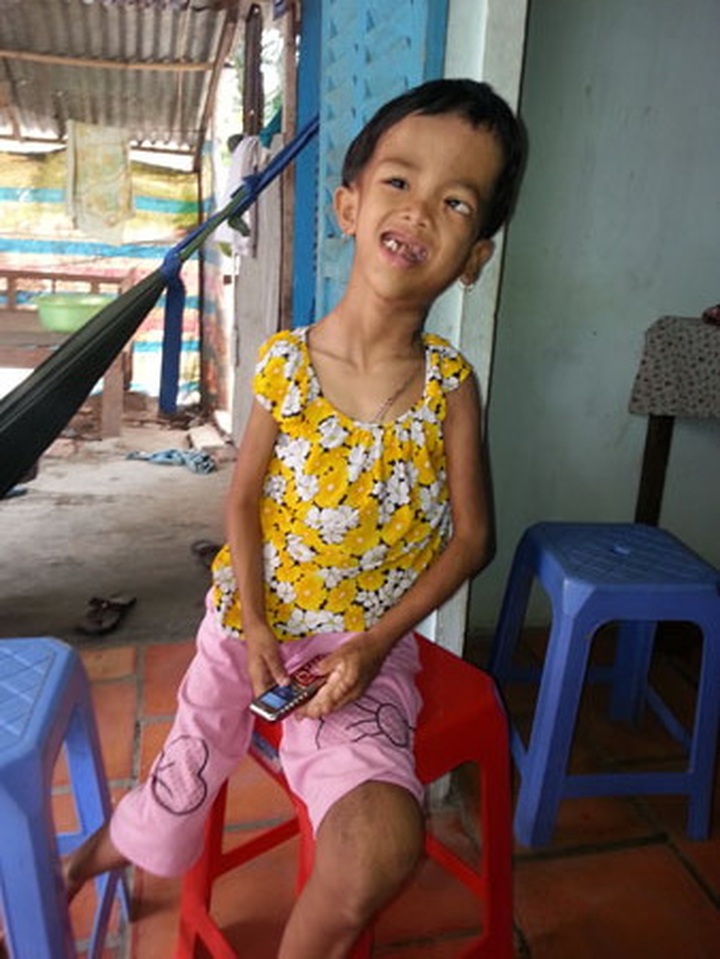 Strange illness deforms little girl's body - 1