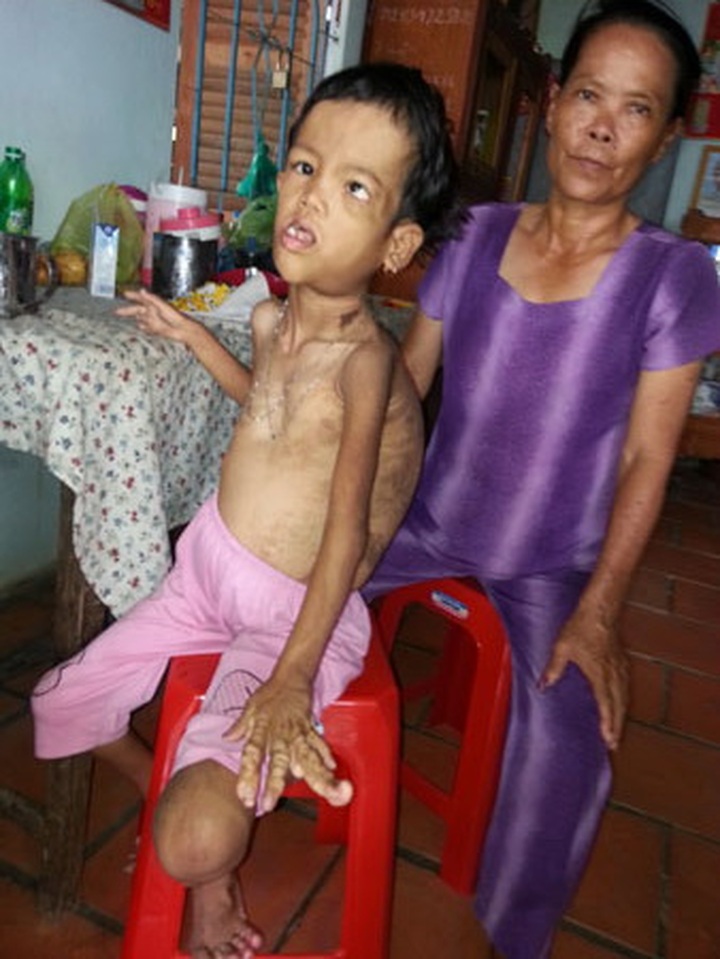 Strange illness deforms little girl's body - 3