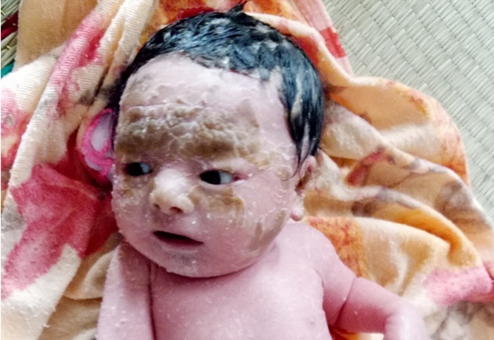 Brothers suffer from fish scale disease - 2 Brothers suffer from fish scale disease - 2