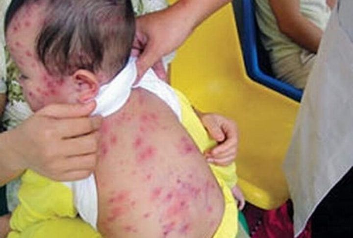Hanoi authorities worry over measles outbreak - 1