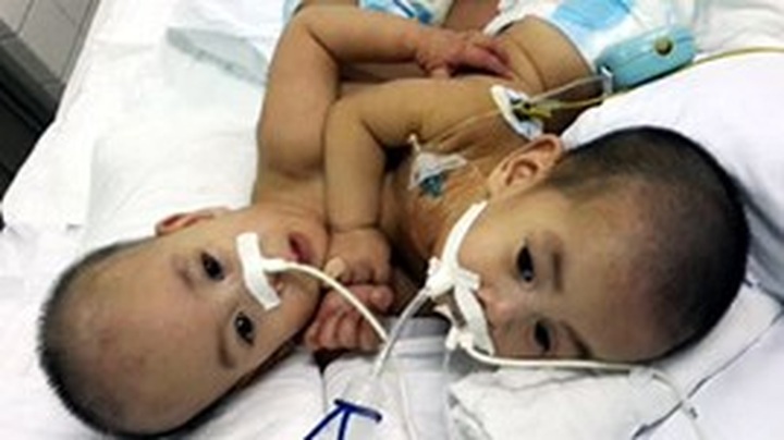 Conjoined twins to be separated in HCM City - 1