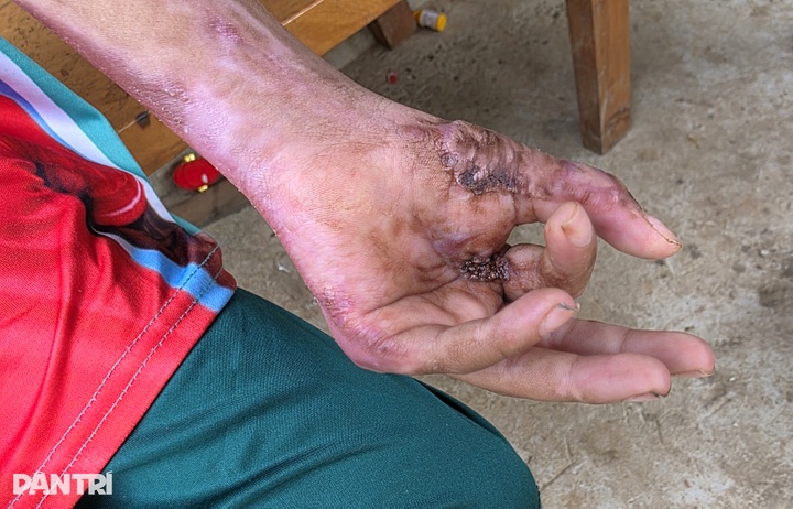 Boy suffers severe burns as treatment costs overwhelm poor family - 4
