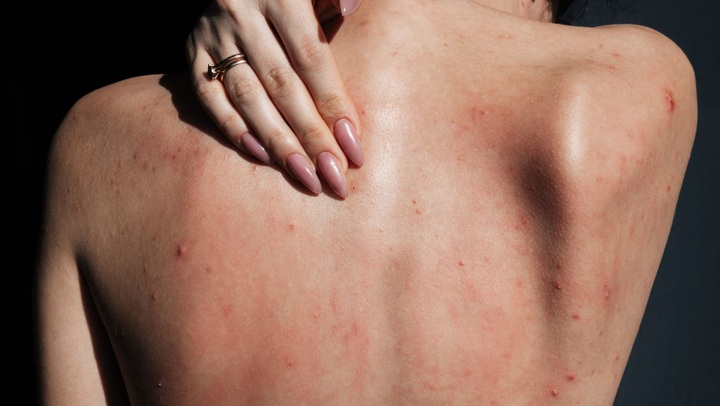 Muối ăn có công dụng giải độc tố cho sản phụ, trị mụn... lưu ý gì khi dùng? - 4 Muối ăn có công dụng giải độc tố cho sản phụ, trị mụn... lưu ý gì khi dùng? - 4