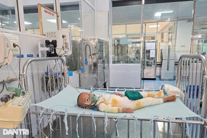 Severely burnt toddler in desperate need of support - 1 Severely burnt toddler in desperate need of support - 1