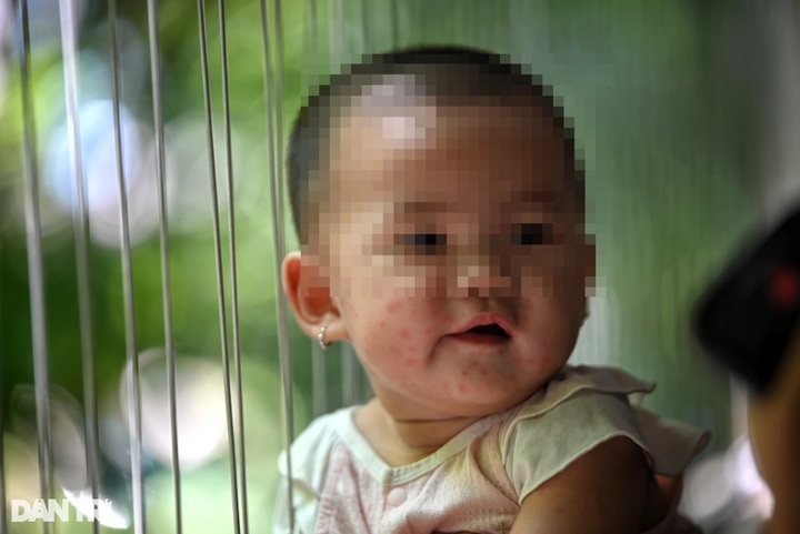 Hand, foot and mouth cases surge at HCM City hospital - 3