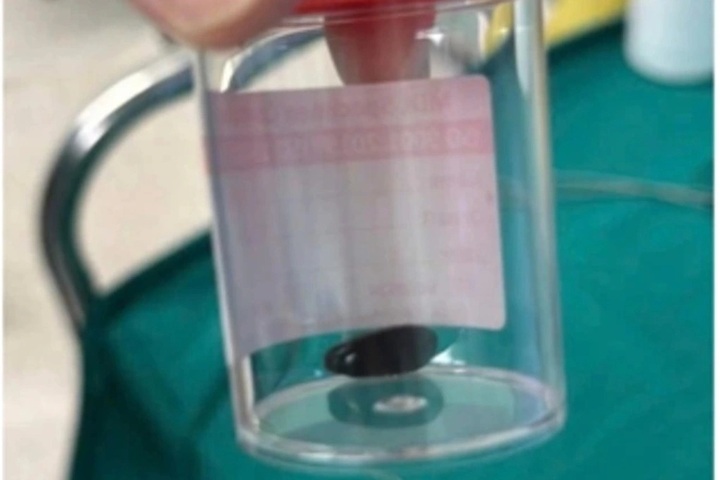 HCM City hospital saves choking Cambodian toddler - 1