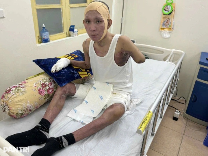 Young man with severe burns receives USD 22,600 in support for treatment - 3 Young man with severe burns receives USD 22,600 in support for treatment - 3