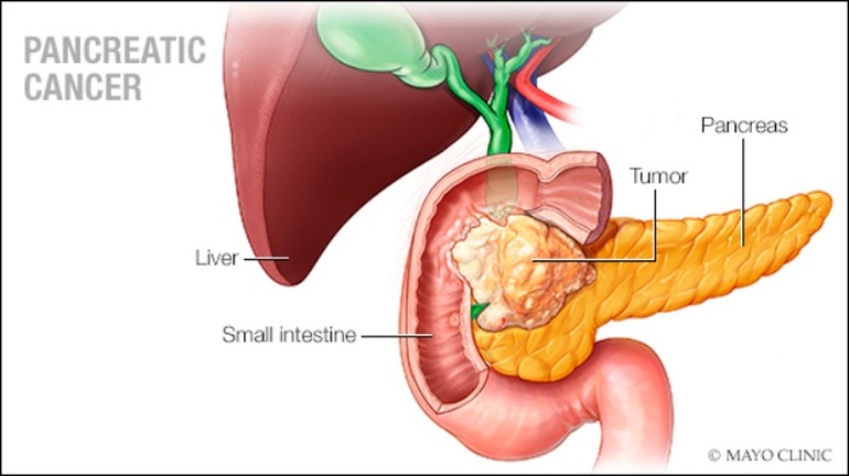 Mắc ung thư tuyến tụy sống được bao lâu? - 2