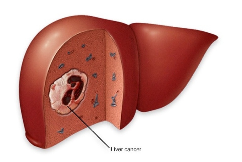 Các yếu tố di truyền nào có thể tăng nguy cơ mắc ung thư gan?
