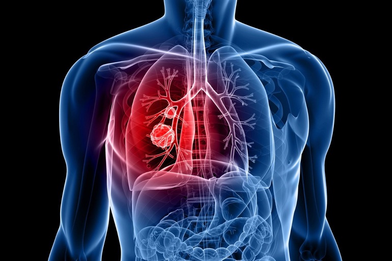 Có những yếu tố nào có thể gia tăng nguy cơ mắc u phổi ác tính?
