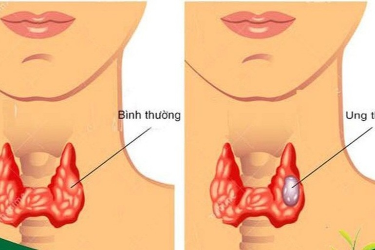 Các phương pháp chính điều trị ung thư tuyến giáp - 1 Các phương pháp chính điều trị ung thư tuyến giáp - 1