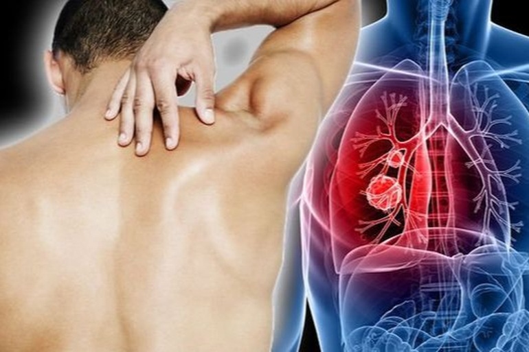 Vì sao ung thư phổi xuất hiện ở người dưới 35 tuổi? | Báo Dân trí