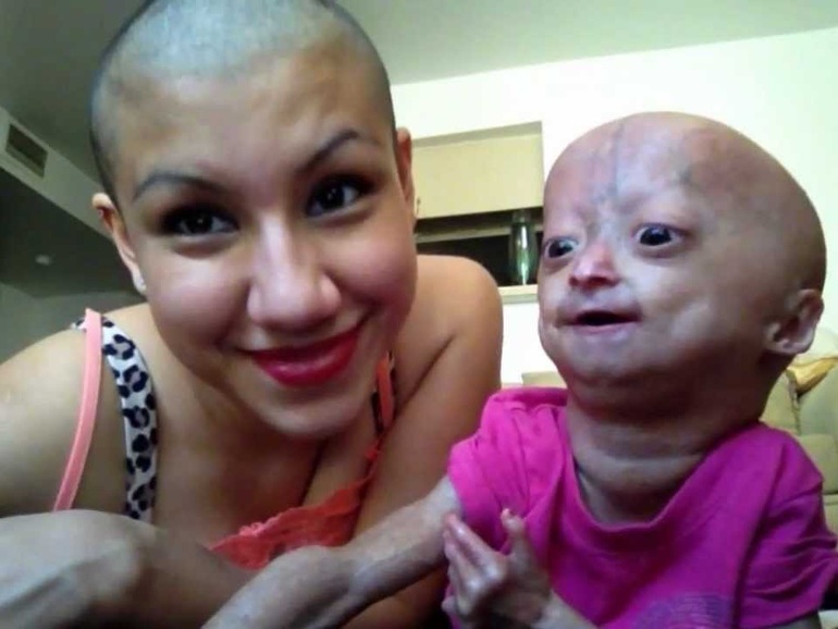 Adalia Rose xuất hiện cùng mẹ trong một đoạn video được đăng tải lên Youtube năm cô 6 tuổi (Ảnh: Youtube). Adalia Rose xuất hiện cùng mẹ trong một đoạn video được đăng tải lên Youtube năm cô 6 tuổi (Ảnh: Youtube).