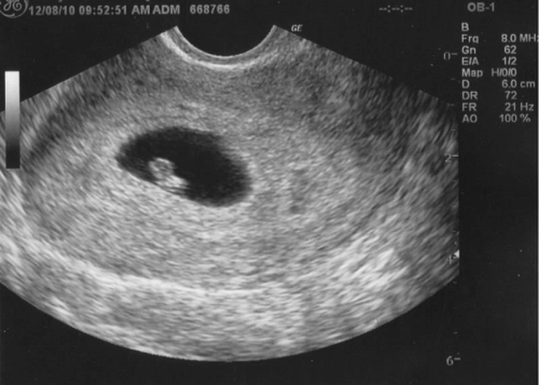Siêu âm 4D là một công nghệ tuyệt vời cho phép bạn nhìn thấy hình ảnh thai nhi thật rõ ràng và sinh động hơn. Hãy khám phá những hình ảnh đẹp và xuất sắc liên quan đến từ khóa này và cảm nhận sự sống động của em bé.