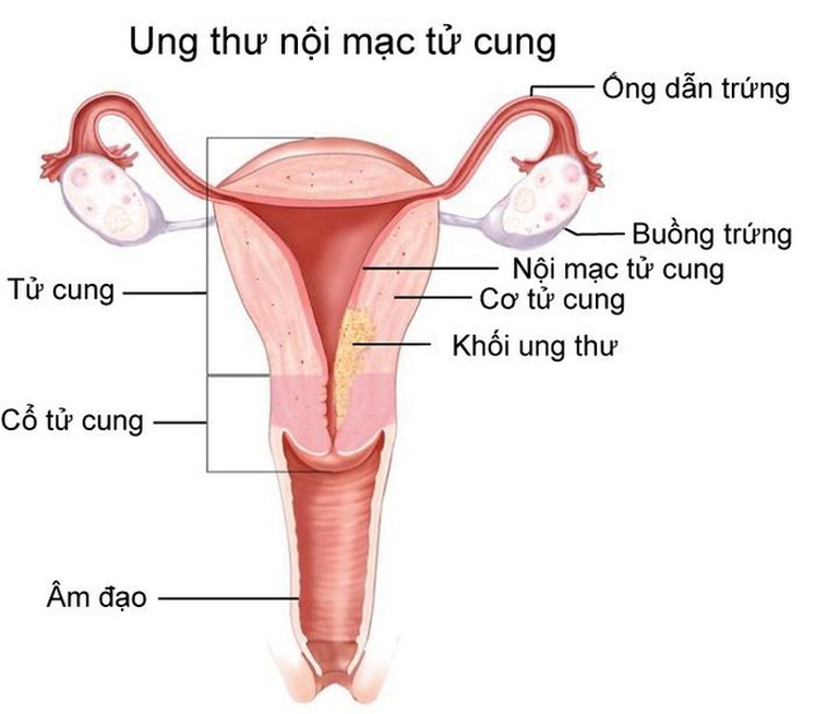 Triệu chứng điển hình cảnh báo ung thư nội mạc tử cung - 1