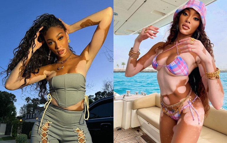 Vitiligo supermodel Winnie Harlow was once shunned by friends - 2