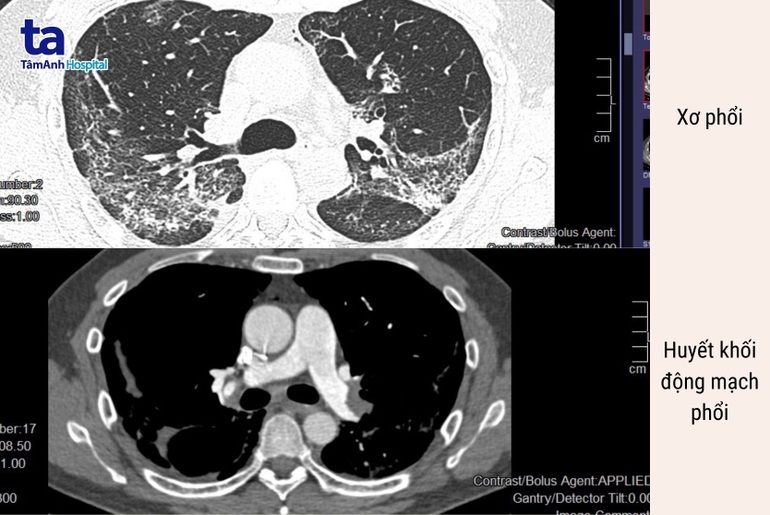 Cẩn trọng xơ phổi, tắc động mạch phổi hậu Covid-19 | Báo Dân trí