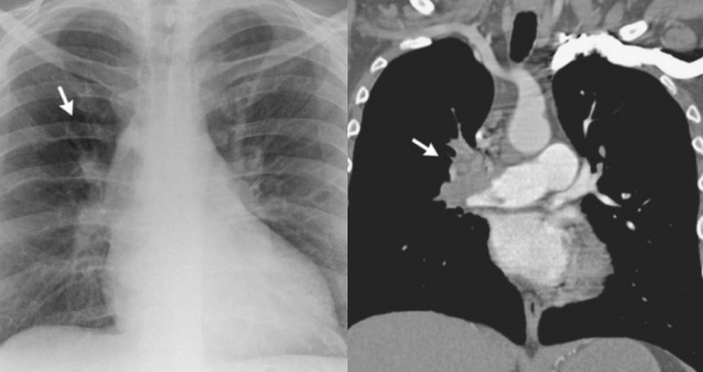 Ho ra máu hậu Covid-19, chàng trai ở Hà Nội phát hiện biến chứng nguy hiểm - 1