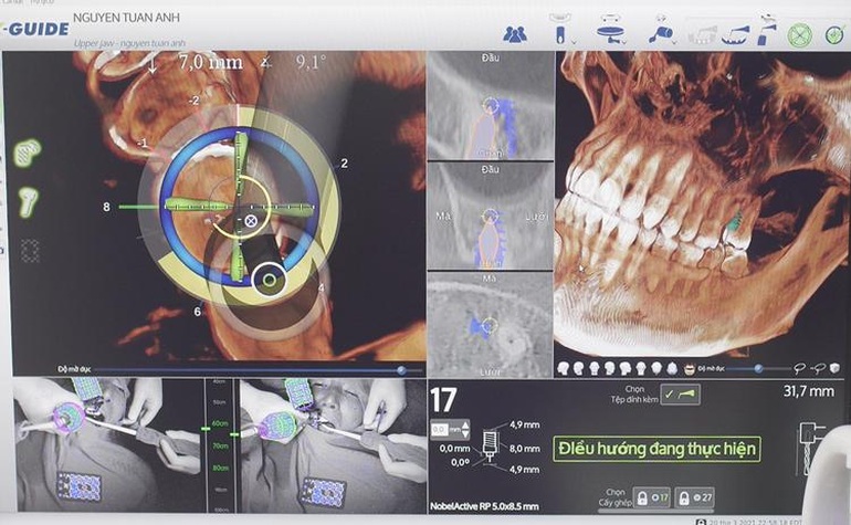 Trồng răng implant 4.0 bằng Robot định vị: An toàn - Không đau - Chính xác tuyệt đối - 3 Trồng răng implant 4.0 bằng Robot định vị: An toàn - Không đau - Chính xác tuyệt đối - 3